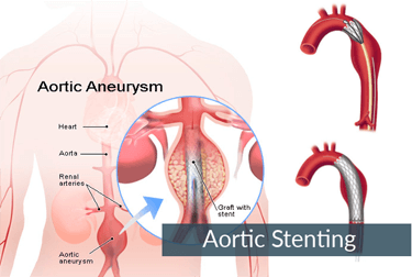 Aortic-Stenting