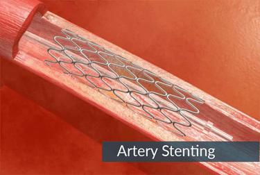 Artery-Stenting