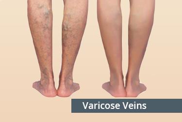 varicocele_treatment